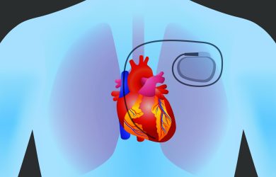 Ce este stimulatorul cardiac