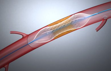 Angioplastia cu stent, principala metoda de revascularizare coronariana