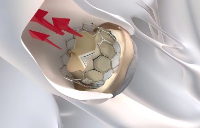 TAVI versus chirurgie pentru stenoza aortică