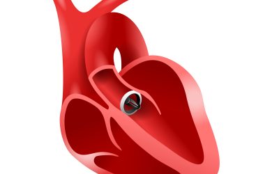 Tratamentul stenozei aortice in Ponderas Academic Hospital